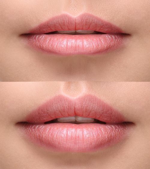 Before and after lip augmentation
